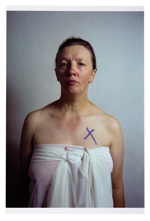 Photo of a woman in a towel with an 'x' over her right breast.