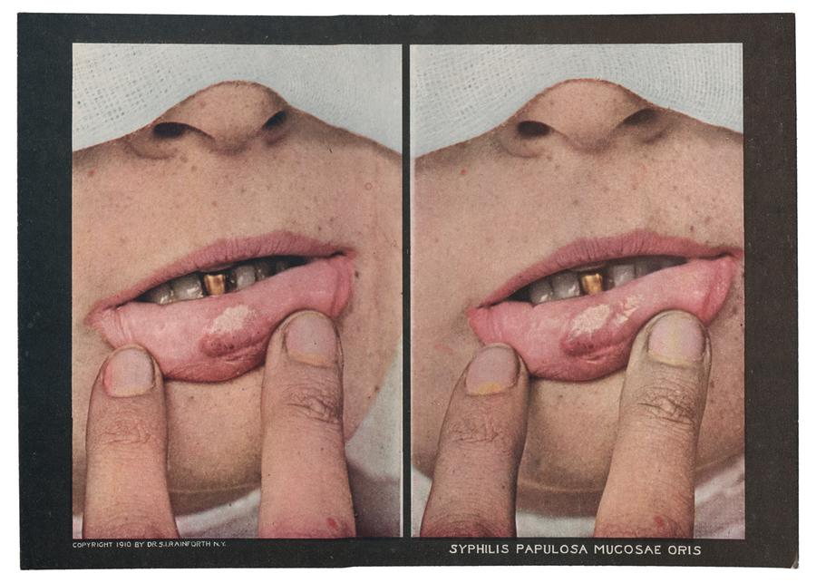 person holds bottom lip down onto chin with fingers to show sores on inner lip