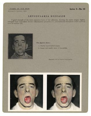 Illness card showing symptoms on man sfflicted with Leucoplakia Buccalis. His tongue is stuck out with sores on it.